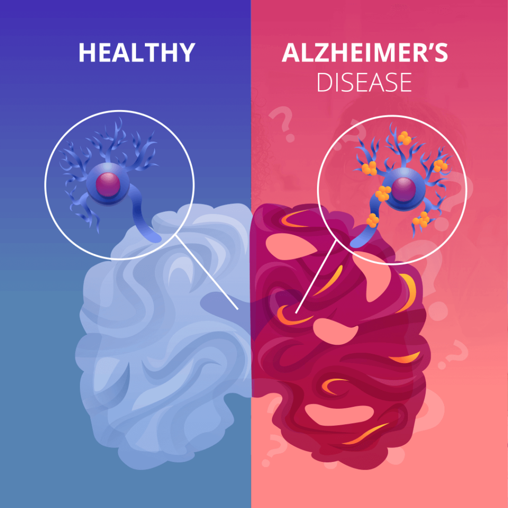 a healthy brain and Alzheimer’s effected brain
